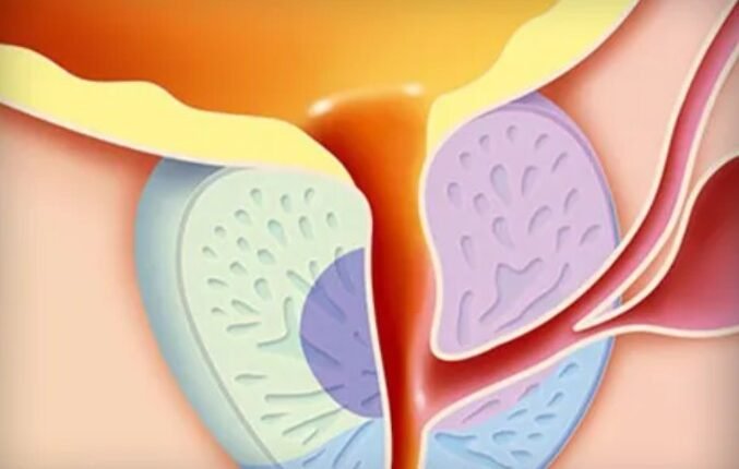 chronic prostatitis treatment